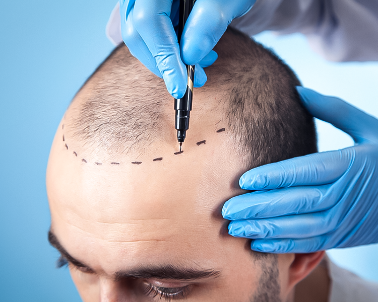 تقنيات زراعة الشعر للرجال وتكلفة العملية ونصائح مهمة قبل الزرع وبعده